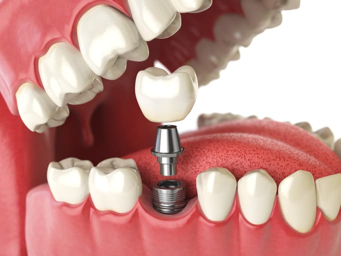 Dental Implant Bone Grafting