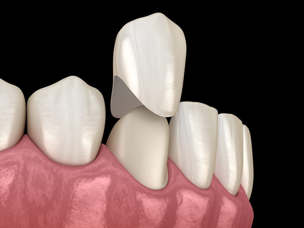 Porcelain Crowns - Keys Dental Specialists