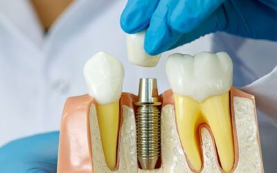 Dental Implant Procedure Overview