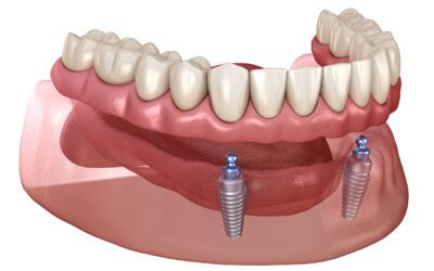 Implant-Supported Overdenture