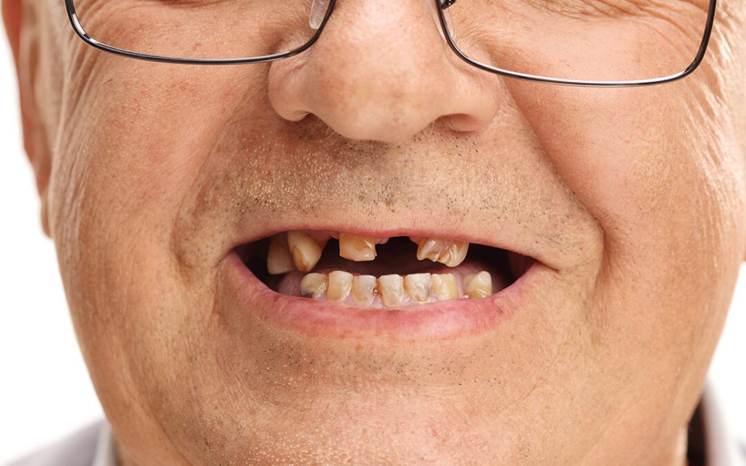 Missing Several Teeth