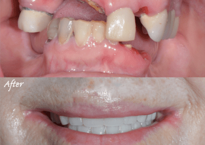 Key West Dentist Patient Transformation Photo