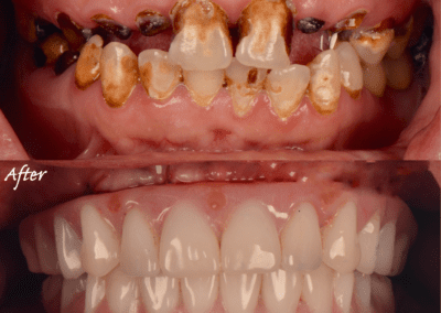 New Teeth by Key West Dentist