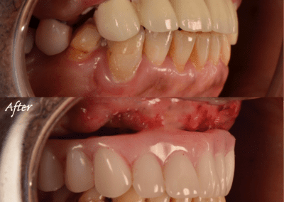 New Teeth by Key West Dentist